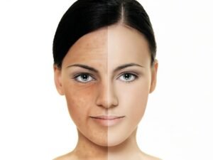 Woman's face split showing uneven skin tone with dark spots on left and clear skin on right side.
