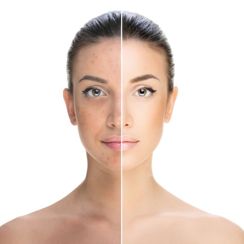 Woman’s face split showing acne and blemishes on one side and clear skin on the other.